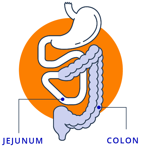 Surgery That Removes the Ileum and Reconnects With Colon